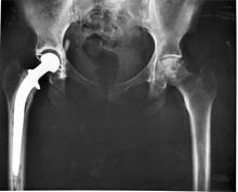 Tratamento de superficie melhora material usado em proteses de articulacoes 